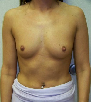 Breast Augmentation