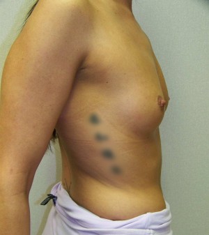 Breast Augmentation