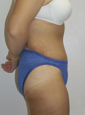 Tummy Tuck (Abdominoplasty)