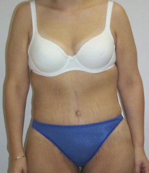 Tummy Tuck (Abdominoplasty)