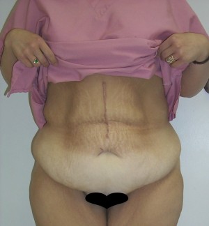 Tummy Tuck (Abdominoplasty)