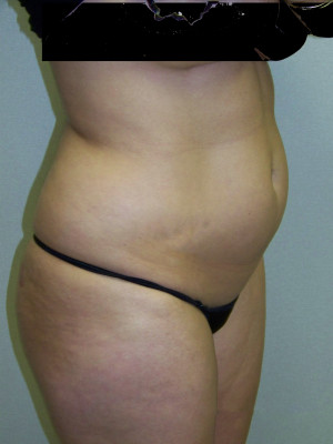 Liposuction Abdomen and Flanks