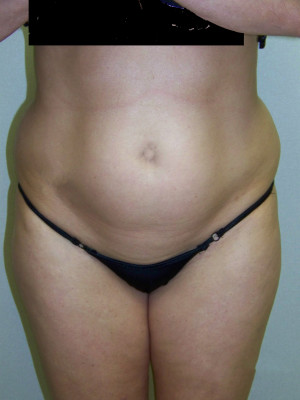 Liposuction Abdomen and Flanks