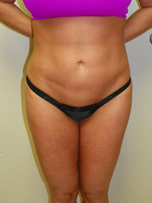 Liposuction Abdomen and Flanks