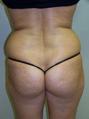 Liposuction Abdomen and Flanks