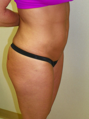 Liposuction Abdomen and Flanks