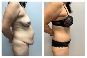 Tummy Tuck (Abdominoplasty)