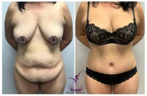 Tummy Tuck (Abdominoplasty)