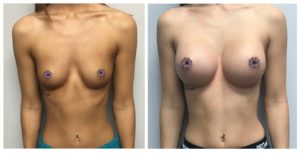 Breast Augmentation