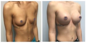 Breast Augmentation