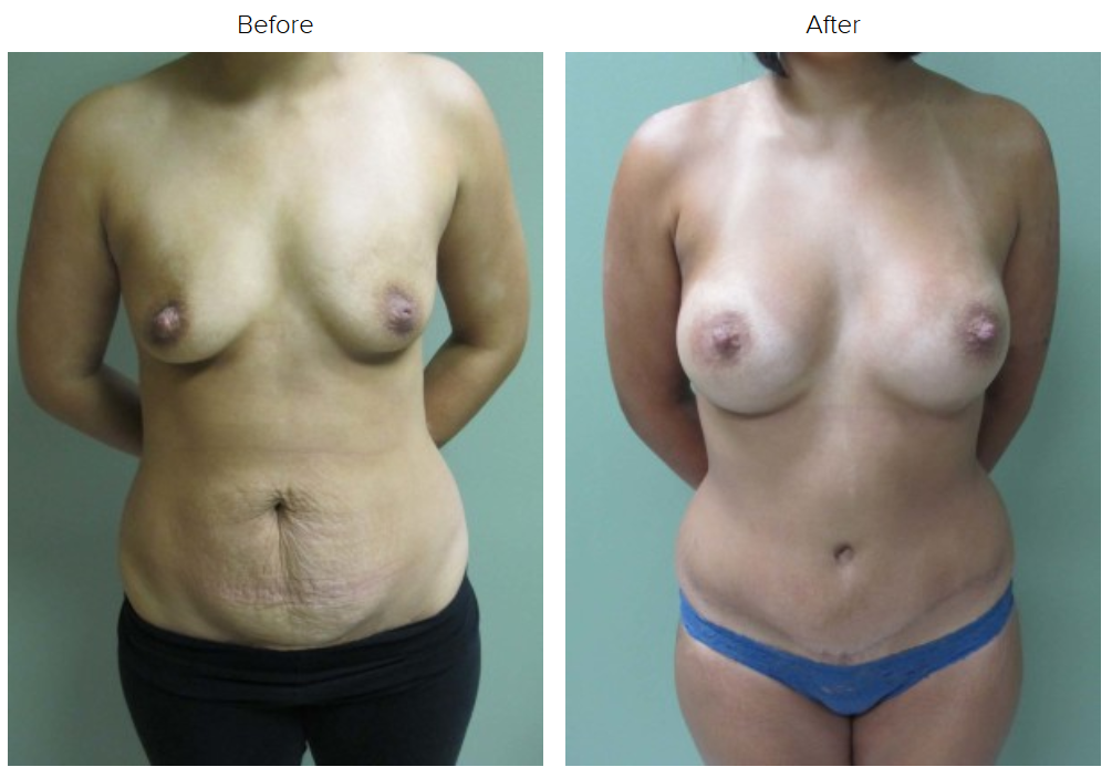 Breast Augmentation img 3