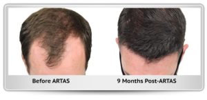 Hair Transplants