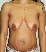 Breast Augmentation