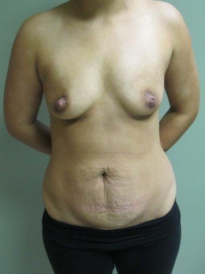 Breast Augmentation