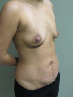 Breast Augmentation