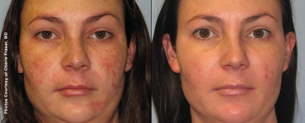 IPL Photofacial with Sciton Forever Young BBL in Austin