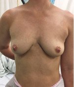 Breast Procedures