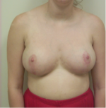 Breast Reduction