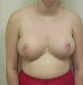 Breast Reduction