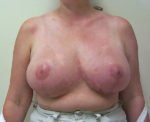 Breast Reduction