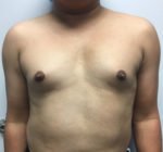 MTF Breast Augmentation