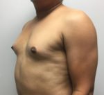 MTF Breast Augmentation