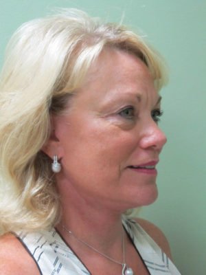 Facelift
