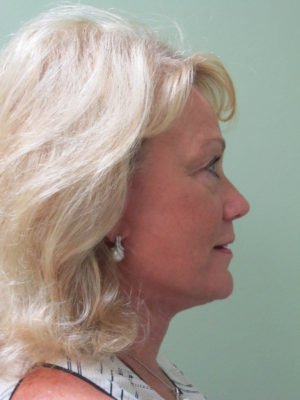 Facelift