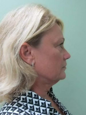 Facelift