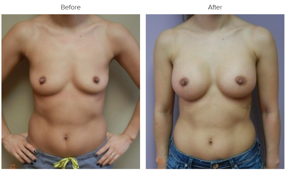 Breast Augmentation img 2