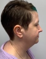 Submental (Chin) Liposuction