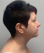 Submental (Chin) Liposuction