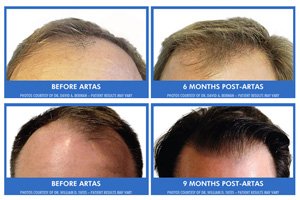 ARTAS iX hair transplant in Austin