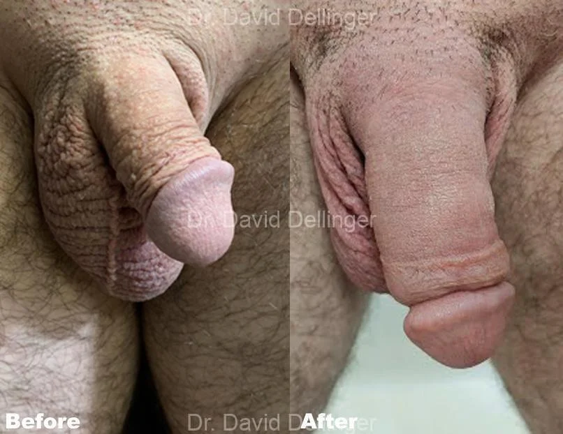 Male enhancement care in Austin and Dallas at Elysian Plastic Surgery