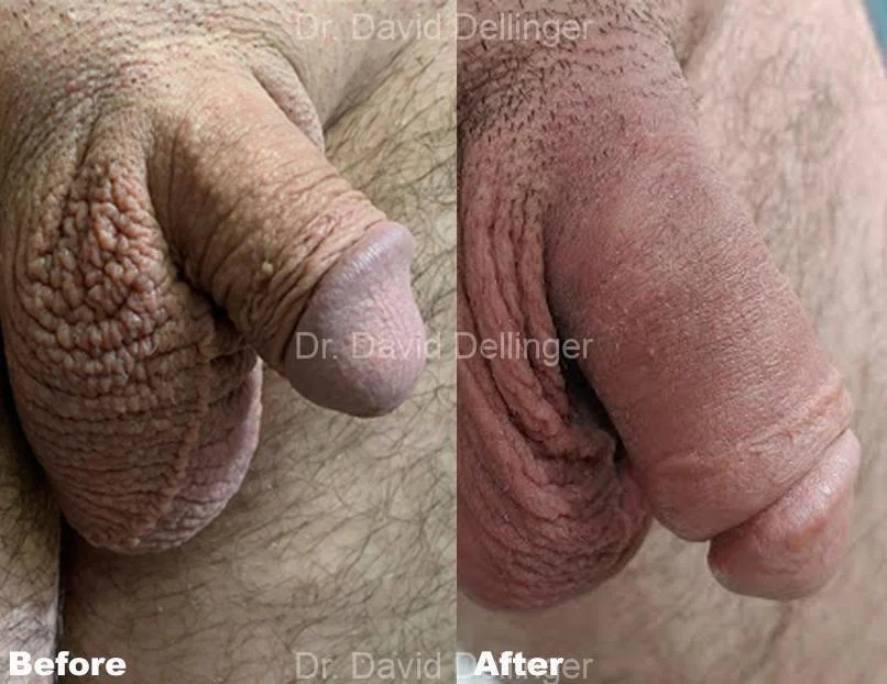 Penis enhancement in Austin and Dallas