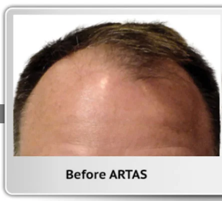 Before hair transplant