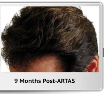 After hair transplant