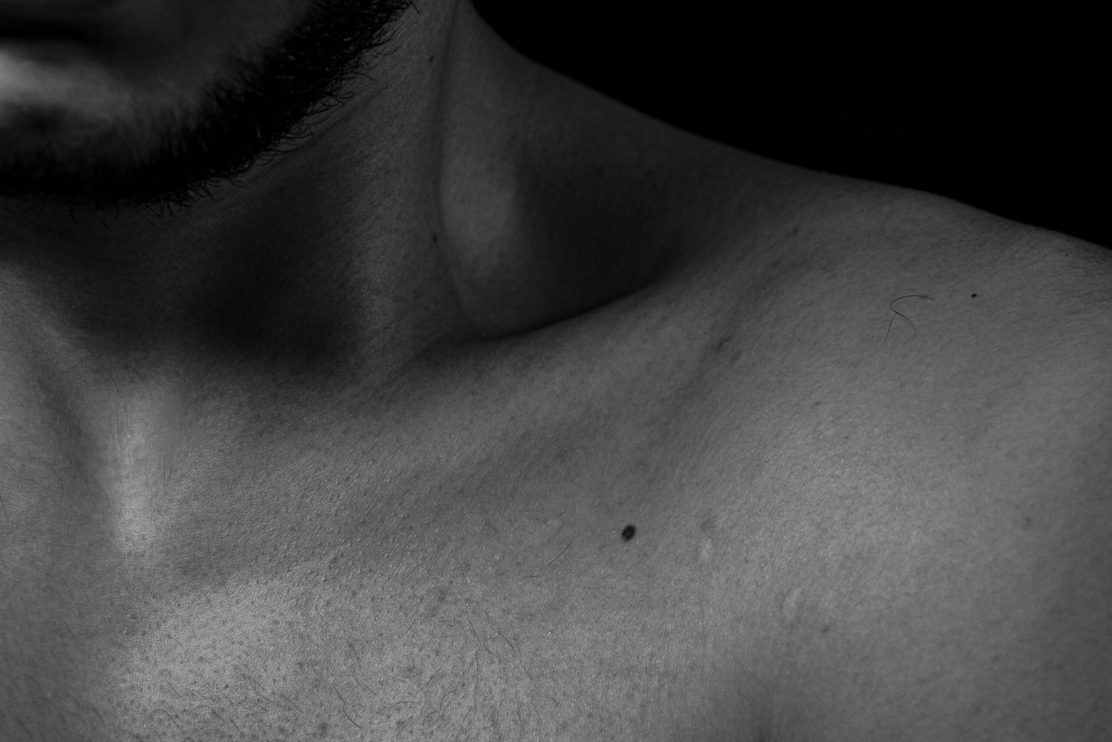 Read more about the article Understanding Gynecomastia: Causes and Treatment