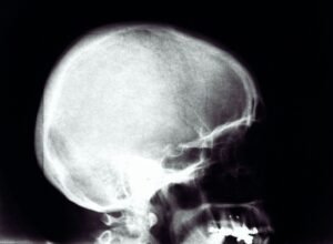 Read more about the article Enhancing Your Figure: The Benefits of Augmentation Mammoplasty