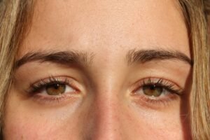 Read more about the article The Cost of Blepharoplasty: What to Expect